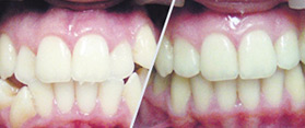 Лечение брекет-системой с удалением зубов