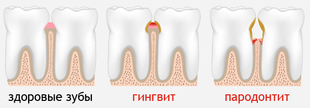 болят зубы запах изо рта болят зубы запах изо рта