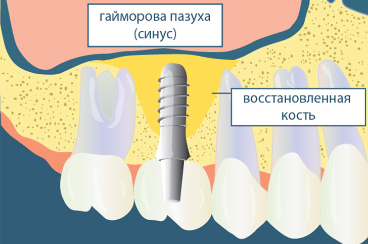 Синус лифтинг - Восстановление костной ткани верхней челюсти